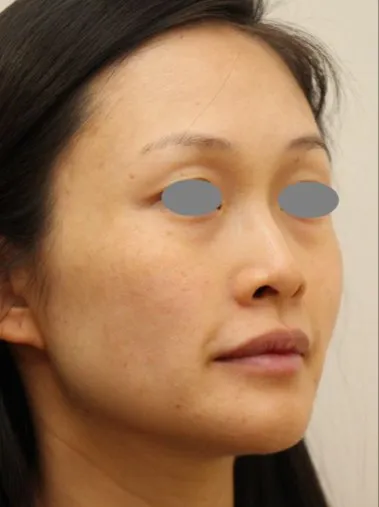 The same three-quarter view after treatment, with the spots cleared and the marks much fainter