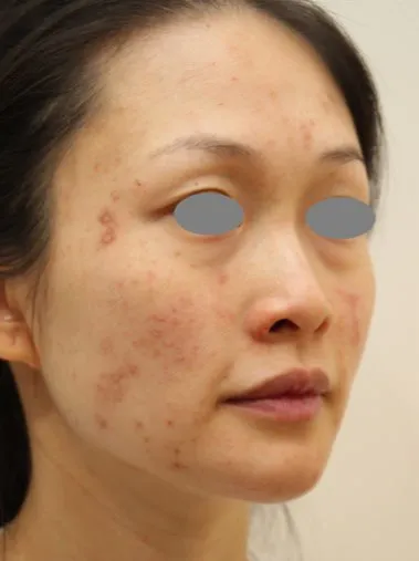 Three-quarter view of a woman’s face before treatment, showing inflamed spots across the cheek and temple over red-brown marks