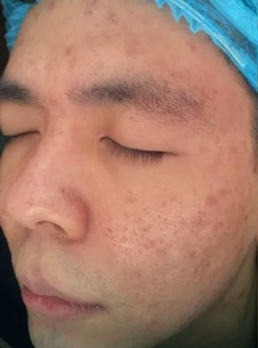 The same three-quarter view after treatment, with far fewer lesions and the redness settled