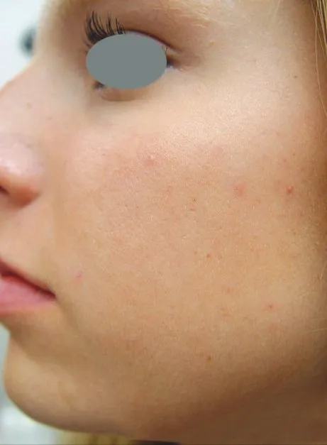 The same cheek close-up after treatment, with the cluster cleared and the redness settled