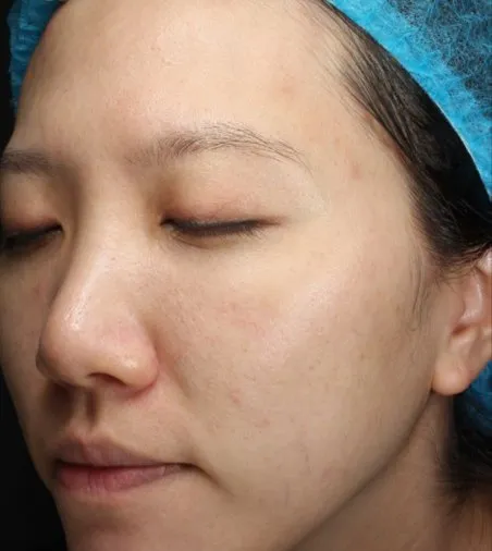 The same three-quarter view after treatment, with the cheek clear and the tone even