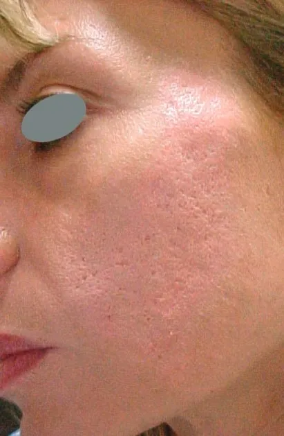 The same cheek close-up after treatment, with the colour much calmer and the surface flatter