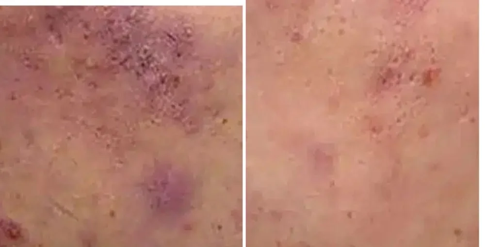 Active Acne Treatment before and after, enlarged: the same person before treatment on the left and after treatment on the right, case 2. Results may vary.