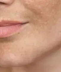 Close-up of age spots and uneven pigment around the cheek and mouth before BBL HEROic treatment in Southlake, TX