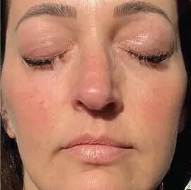 The same woman after BBL HEROic, with lighter under-eye shadowing and calmer, more even colour across the cheeks
