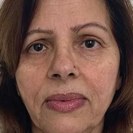 Front view of a woman before BBL HEROic, showing dull, uneven tone with brown pigment across the cheeks and forehead