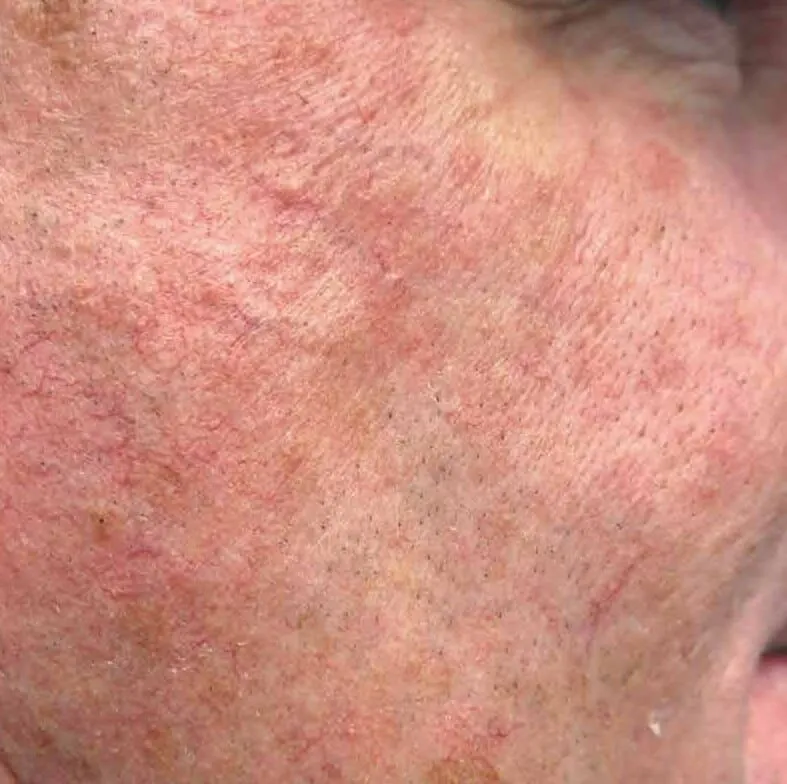Close-up of a cheek before BBL HEROic, showing widespread redness and fine broken capillaries