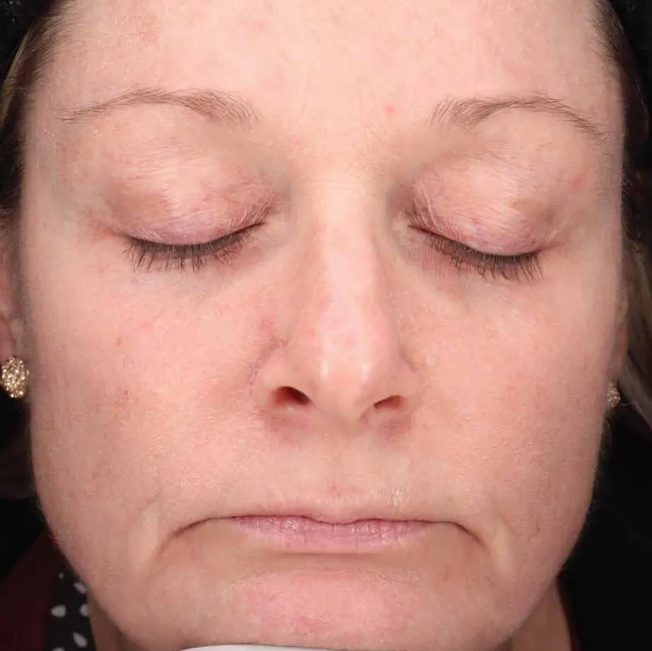 The same lower face after BBL HEROic, with the redness calmed and the small brown spots faded