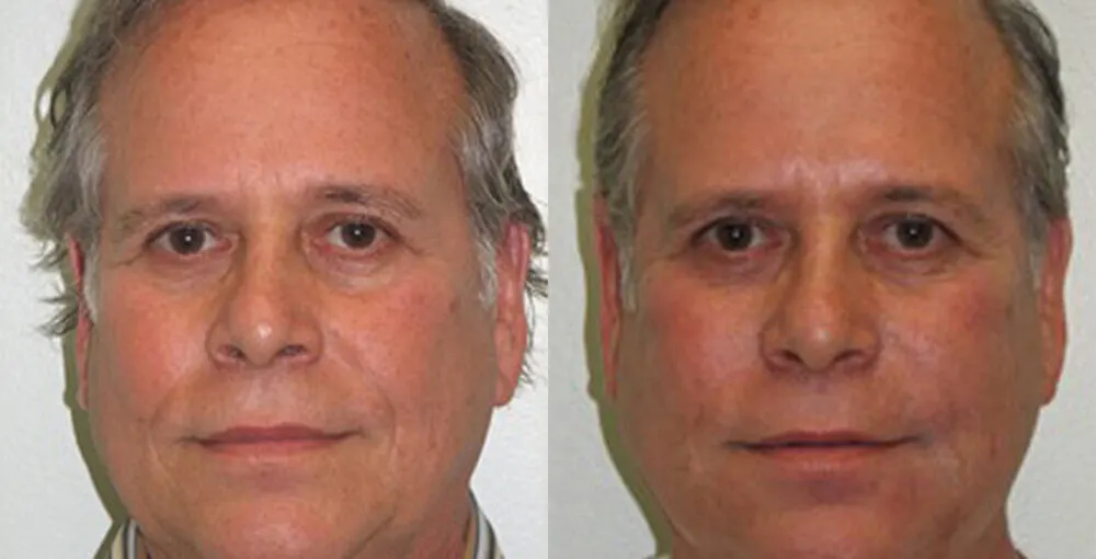 Bellafill before and after: the same person before treatment on the left and after treatment on the right, case 2. Results may vary.