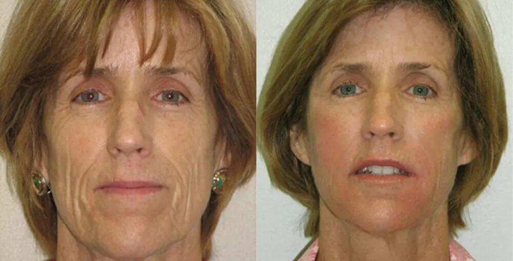 Bellafill before and after: the same person before treatment on the left and after treatment on the right, case 3. Results may vary.