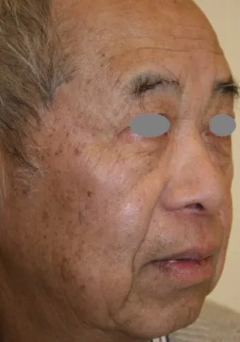 The same three-quarter view after benign lesion removal, with the cheek and temple clear