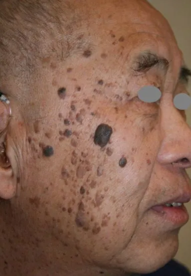 Three-quarter view of an older man’s face before benign lesion removal, showing raised dark brown lesions massed over the cheek and temple