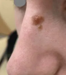 Close-up of the side of a nose before benign lesion removal, showing a single raised brown lesion