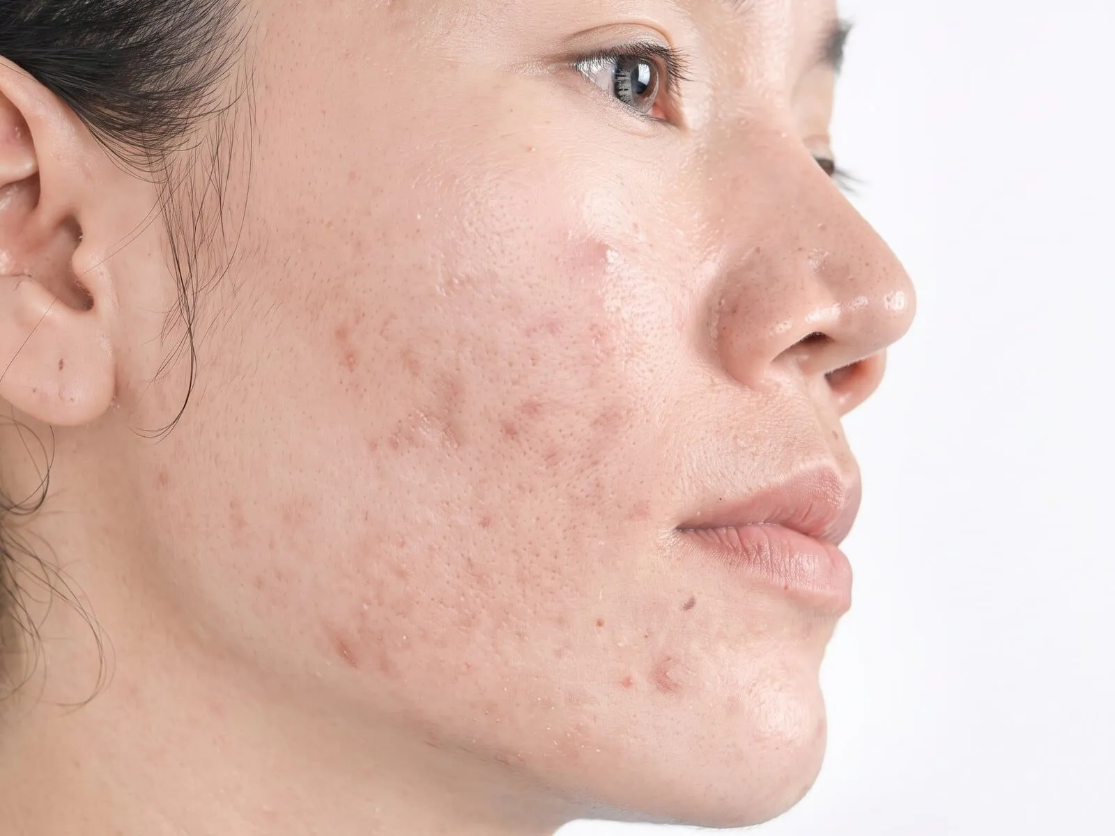 Close-up of the lower cheek and jawline of a woman in three-quarter profile, scattered with the flat pink-brown post-inflammatory marks and shallow rolling scars that healed breakouts leave behind