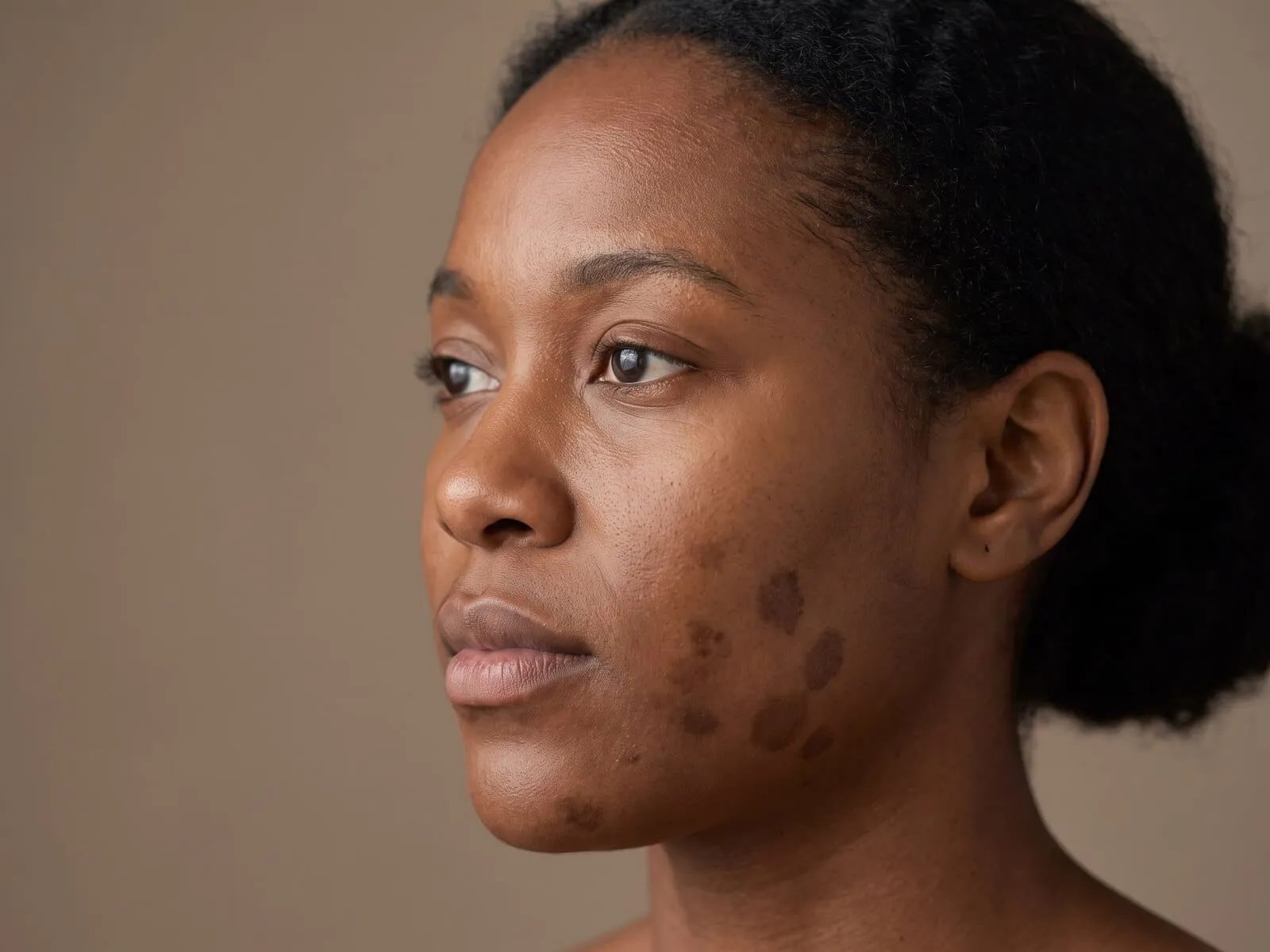 Close-up of a cheek and jawline with patches of post-inflammatory pigmentation, one of the concerns SkinPen microneedling is used for