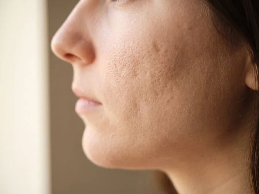 Shallow textured acne scarring with residual brown pigment across a young woman’s cheek