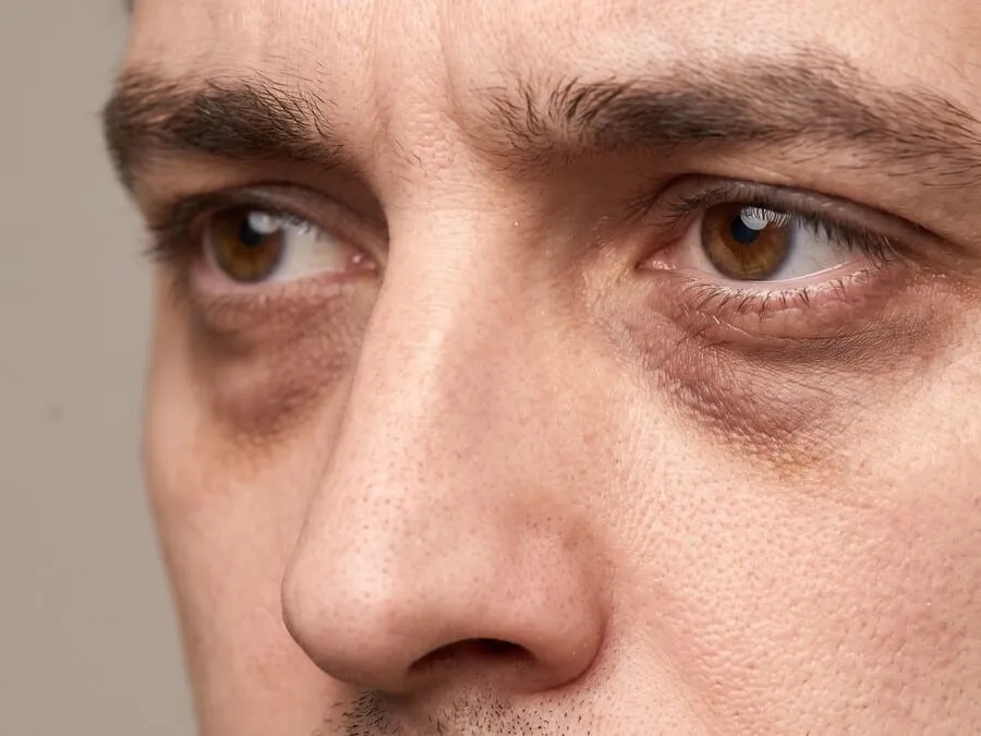 Brown-violet half-moon shadowing beneath both of a man’s eyes, deepest at the inner tear troughs