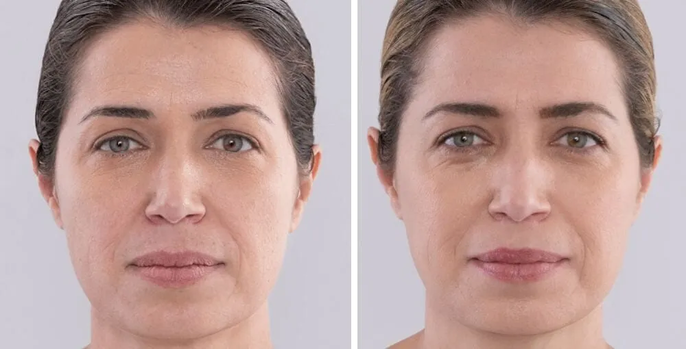 Sculptra before and after