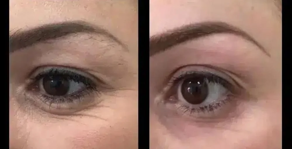 Eyelase before and after, enlarged: the same person before treatment on the left and after treatment on the right, case 2. Results may vary.