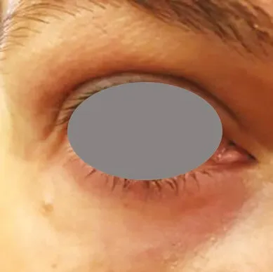 The same eye after treatment, with the outer-corner lines shallower and the upper lid reading smoother