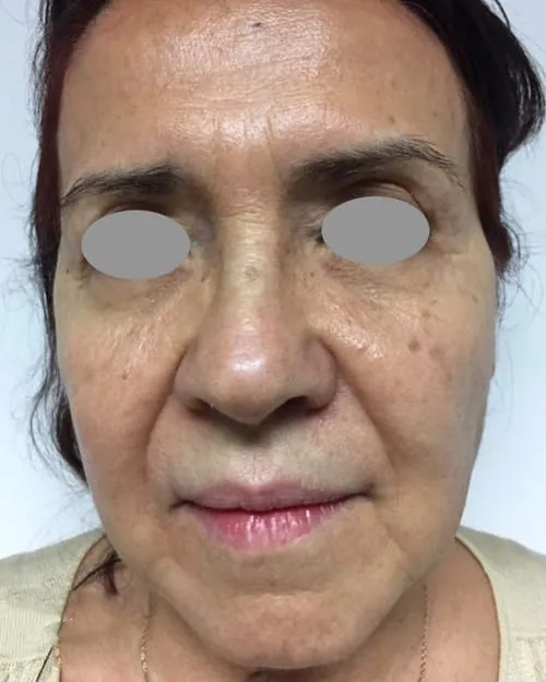 Front view of a woman’s face before a Fotona 4D facelift, showing darker patches across the cheeks alongside nasolabial folds