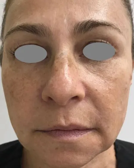 The same front view after a Fotona 4D facelift, with the cheek fuller and the folds softer