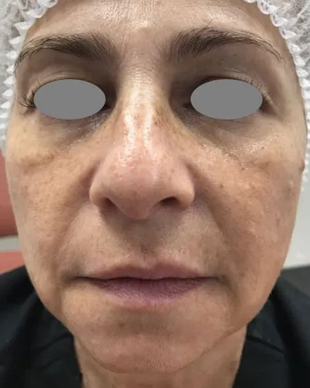 Front view of a woman’s face before a Fotona 4D facelift, showing nasolabial folds with hollowing under the eyes and a slack lower cheek