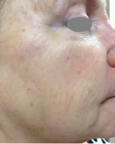 The same cheek after a Fotona 4D facelift, with the lines much shallower and the skin smoother