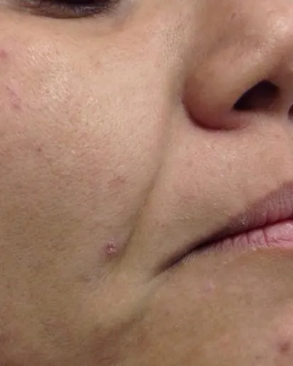 The same mouth corner after a Fotona 4D facelift, with the line softer and the jaw firmer