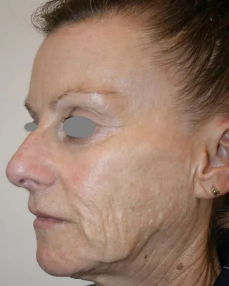 Three-quarter view of a woman’s cheek before a Fotona 4D facelift, showing deep lines across the cheek and in front of the ear