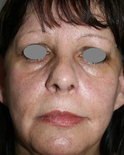 Front view of a woman’s face before a Fotona 4D facelift, showing sallow tone with nasolabial folds and a slack lower cheek