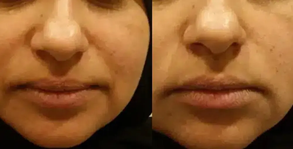 Fotona 4D Facelift before and after: the same person before treatment on the left and after treatment on the right, case 2. Results may vary.