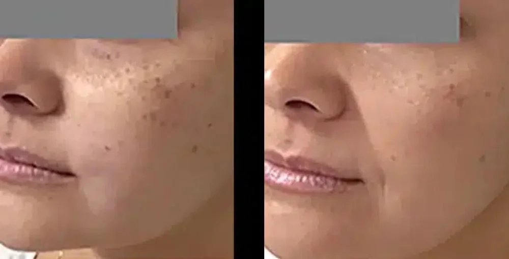 Fotona 4D Facelift before and after, enlarged: the same person before treatment on the left and after treatment on the right, case 5. Results may vary.