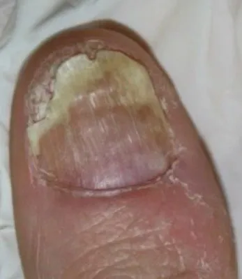 Close-up of a big toenail before laser fungal nail treatment, showing dense yellow discolouration across the plate and a ragged lifting edge
