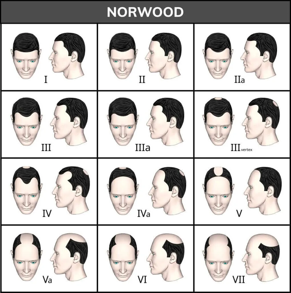 The Norwood-Hamilton scale of male pattern hair loss, illustrated as twelve stages from I to VII showing progressive temple recession and crown thinning in front and profile view