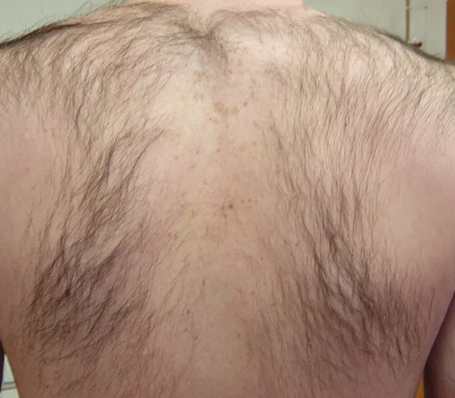 Upper back and shoulders of a man before laser hair removal, covered in dense dark hair