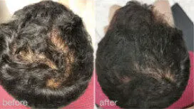 HaiRestart before and after: the same person before treatment on the left and after treatment on the right, case 1. Results may vary.