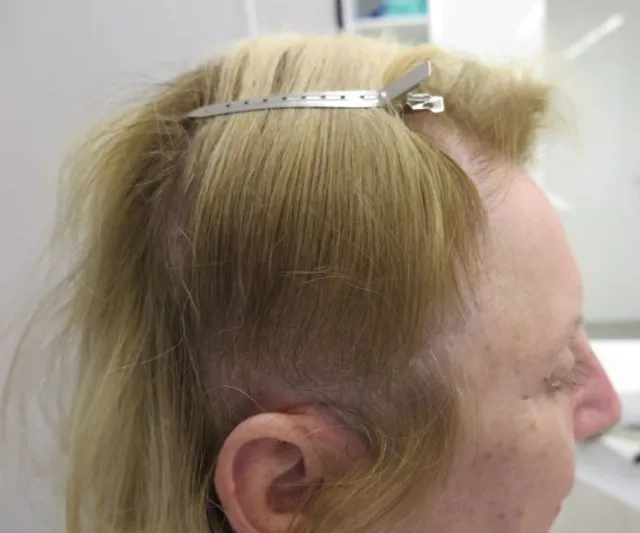 The same view after a course of HaiRestart, with the temple and hairline carrying more hair