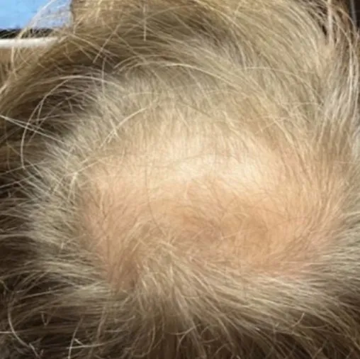 Top-down view of a woman’s scalp before HaiRestart, showing a wide bare area running back from the part