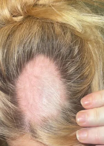 Close-up of a woman’s scalp before HaiRestart, showing a smooth round patch of complete hair loss
