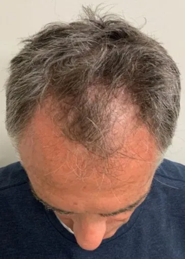 Top-down view of a man’s head before HaiRestart, showing a receded frontal hairline and a thin mid-scalp
