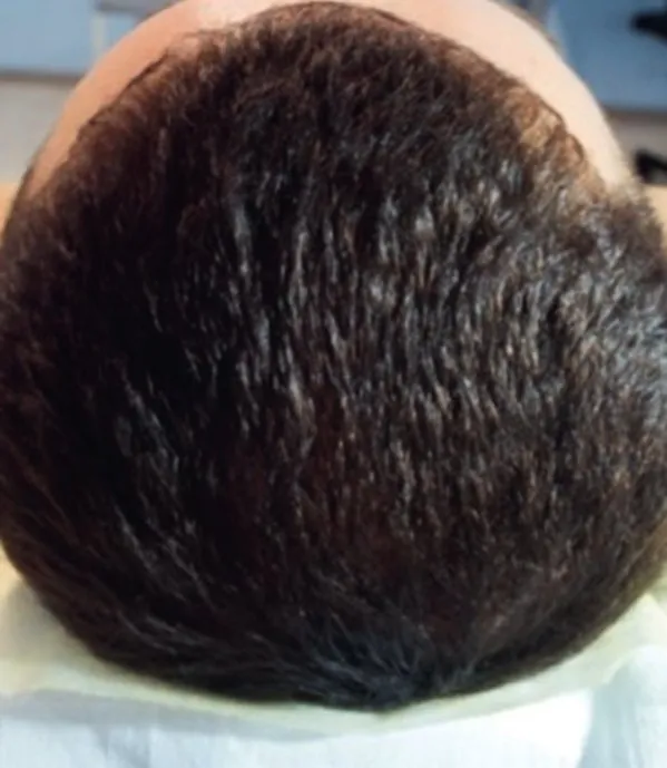 The same crown after a course of HaiRestart, with the patch covered and the hair reading continuous