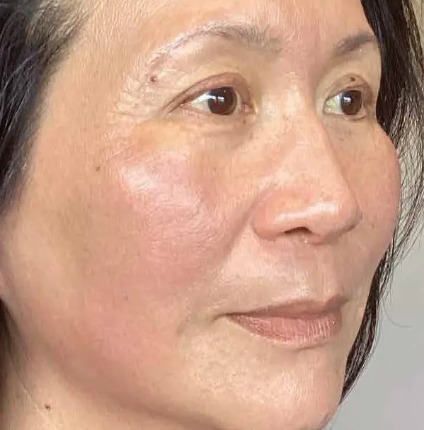 The same three-quarter view after treatment, with the cheek reading even and the surface smoother