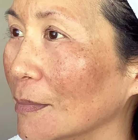 The other three-quarter view of the same woman before treatment, showing dense freckling and brown spots over the cheek and towards the jaw