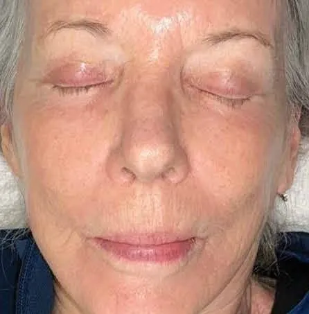 The same front view after treatment, with the scattered spotting faded and the tone more even