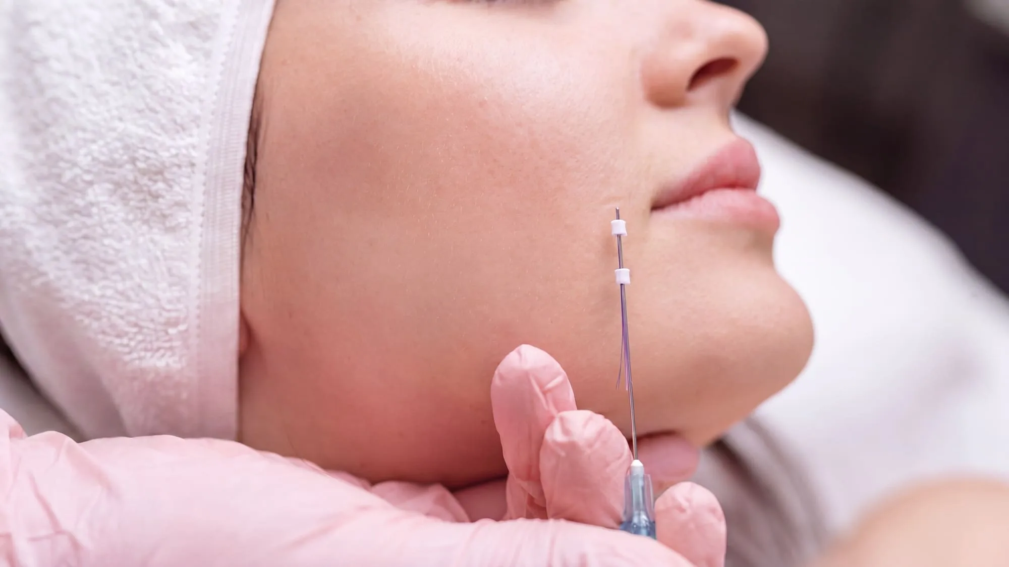 A patient lying back on a white towel and pillow while a gloved clinician places a fine PDO thread cannula into her cheek, the thread's lilac strands visible above the needle