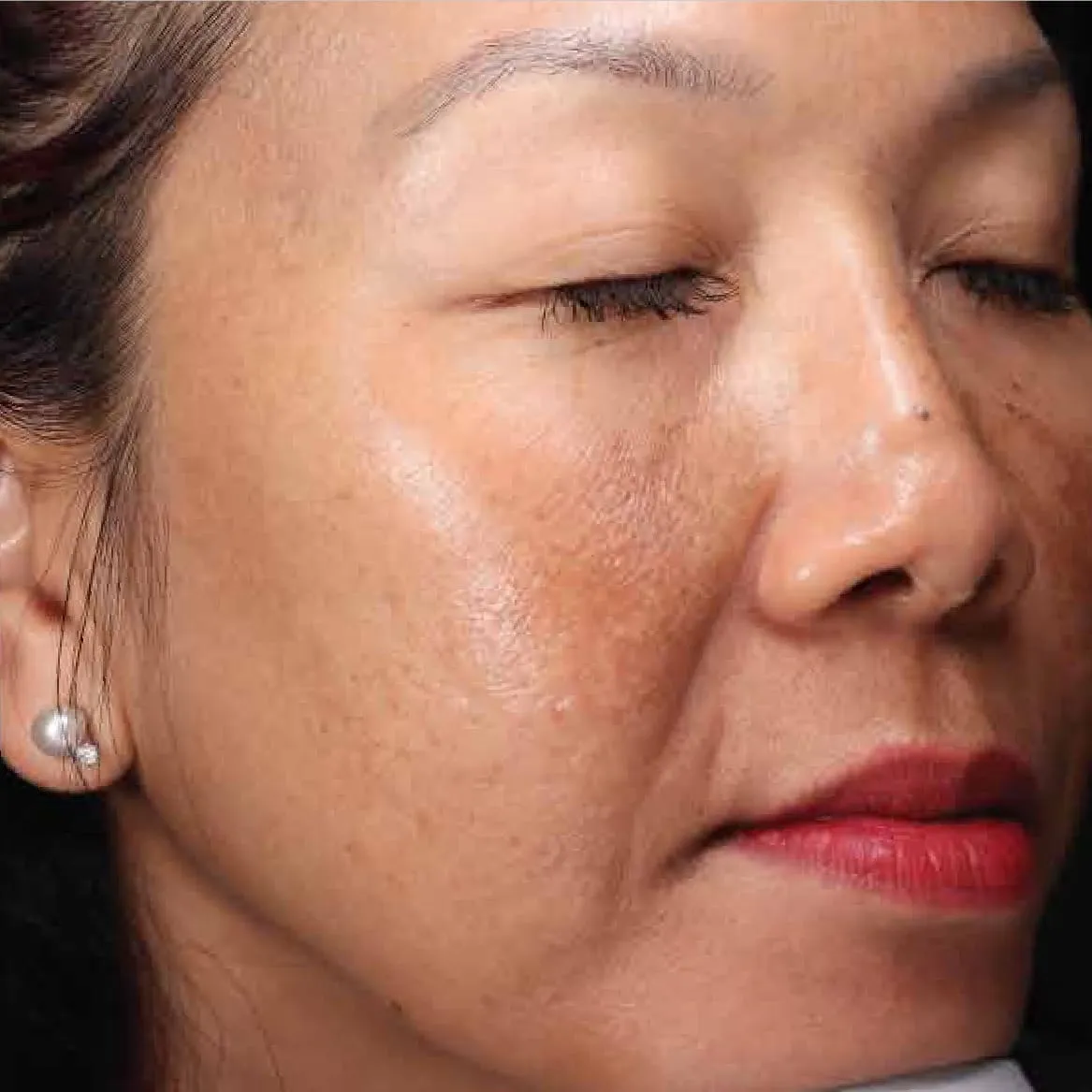 Three-quarter view of a woman before pigment treatment, showing brown patches spread across the cheek and temple with freckling over the nose