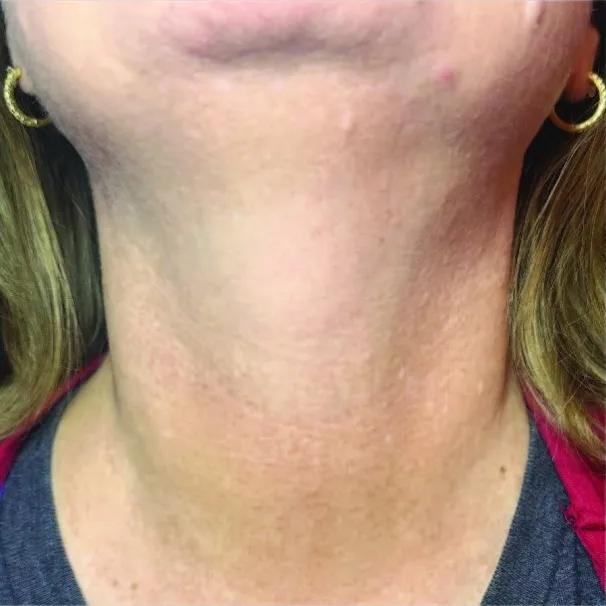 The same neck and upper chest after pigment treatment, with the mottled discolouration much reduced and the tone more even