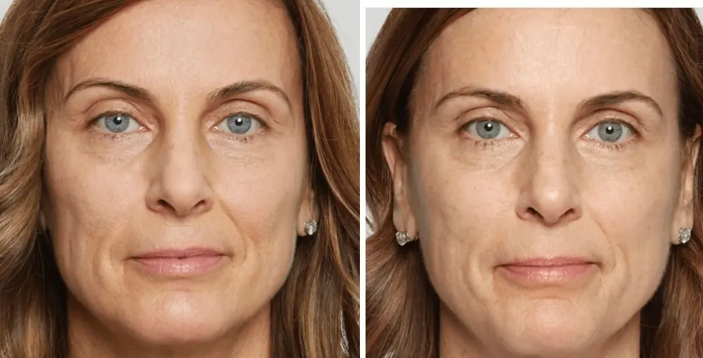 Juvederm before and after: the same person before treatment on the left and after treatment on the right, case 5. Results may vary.