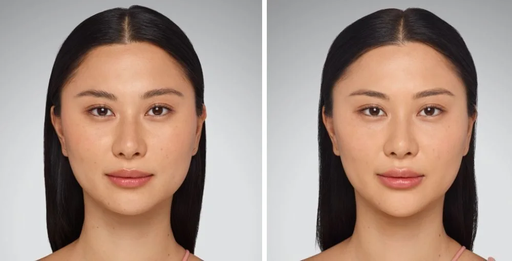 Juvederm before and after, enlarged: the same person before treatment on the left and after treatment on the right, case 7. Results may vary.